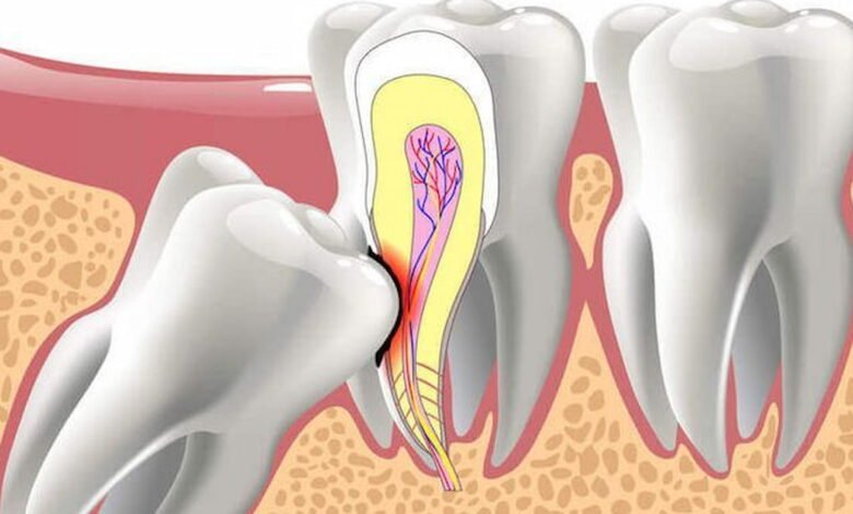 What Causes Impacted Teeth? Understanding the Root of the Issue