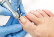 Why Ingrown Toenails Happen: Common Causes You Should Know