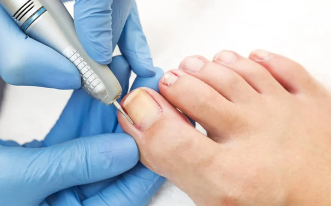 Why Ingrown Toenails Happen: Common Causes You Should Know
